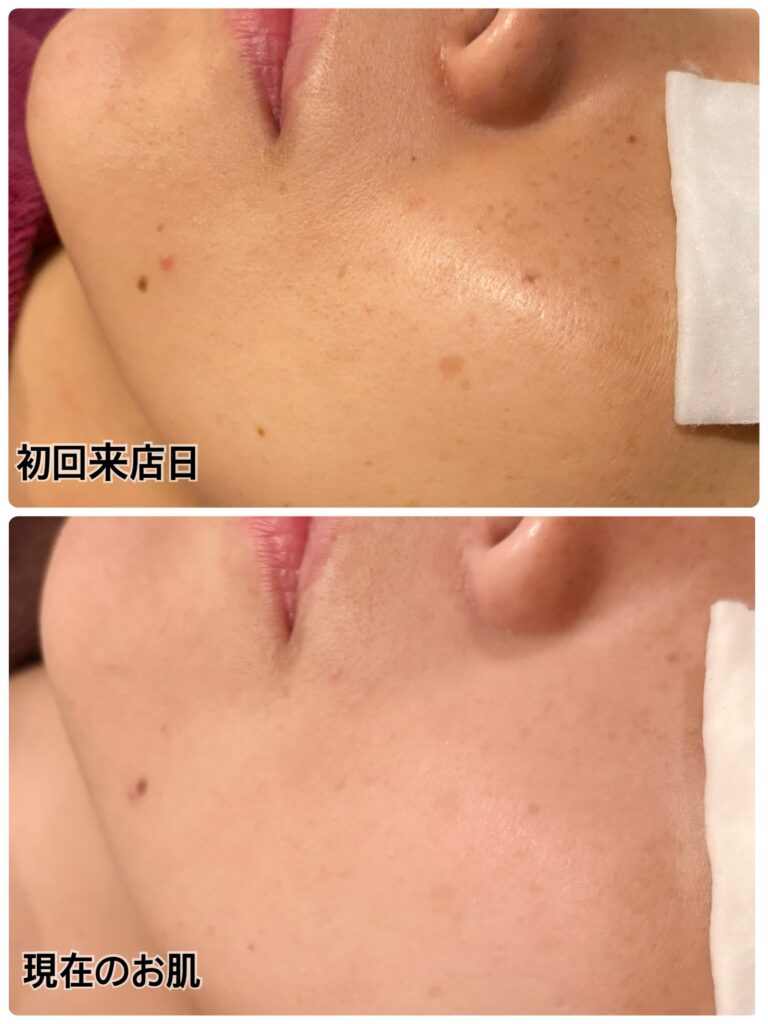 シミ、くすみ、お肌のたるみ、ハリに効果が期待でします