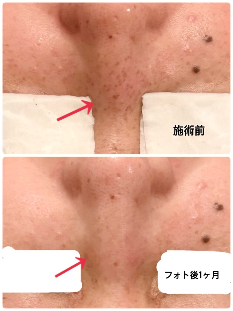 そばかす、しみ、くすみ